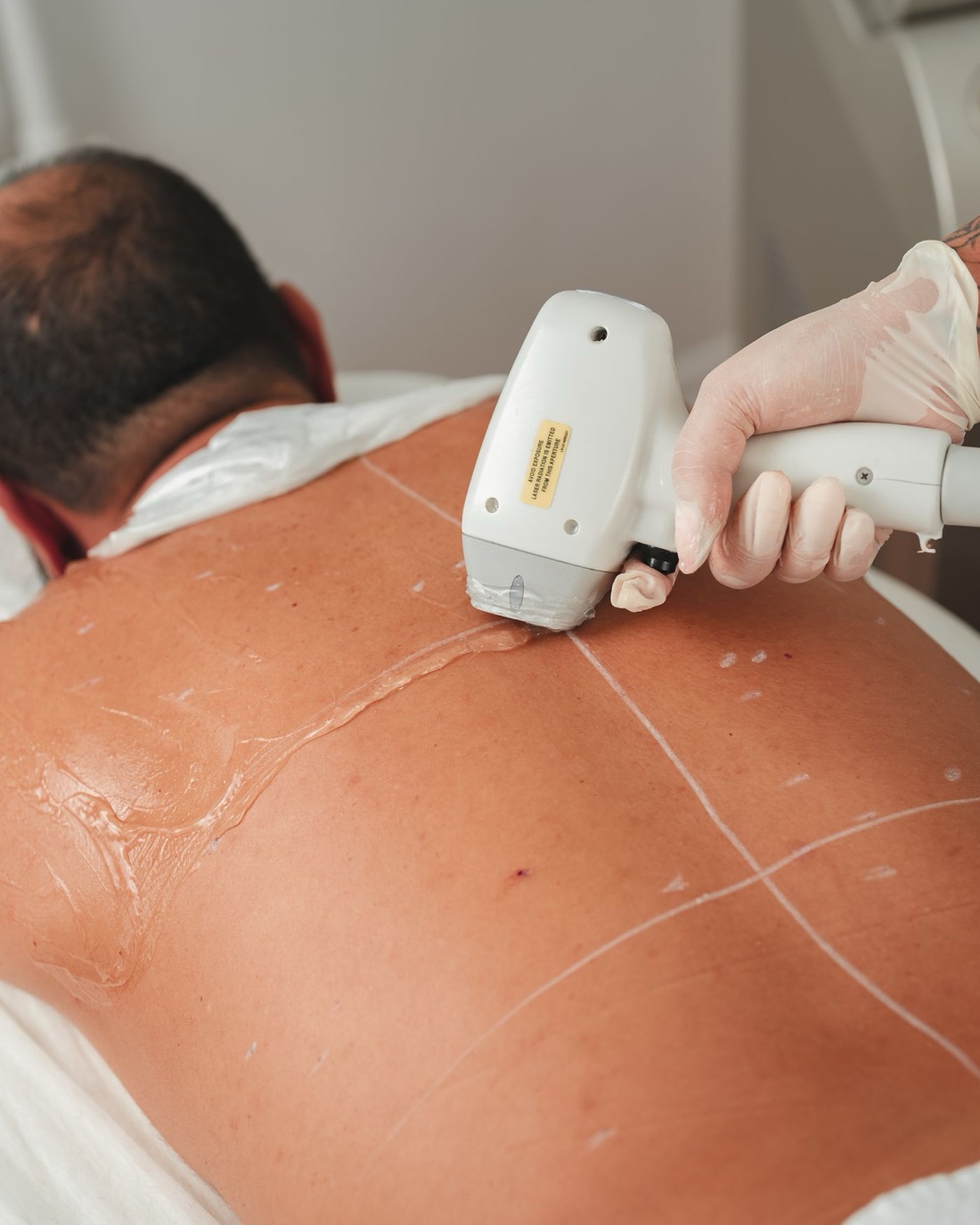 Laser Haarentfernung am Rücken eines Mannes mit dem Diodenlaser-Handstück