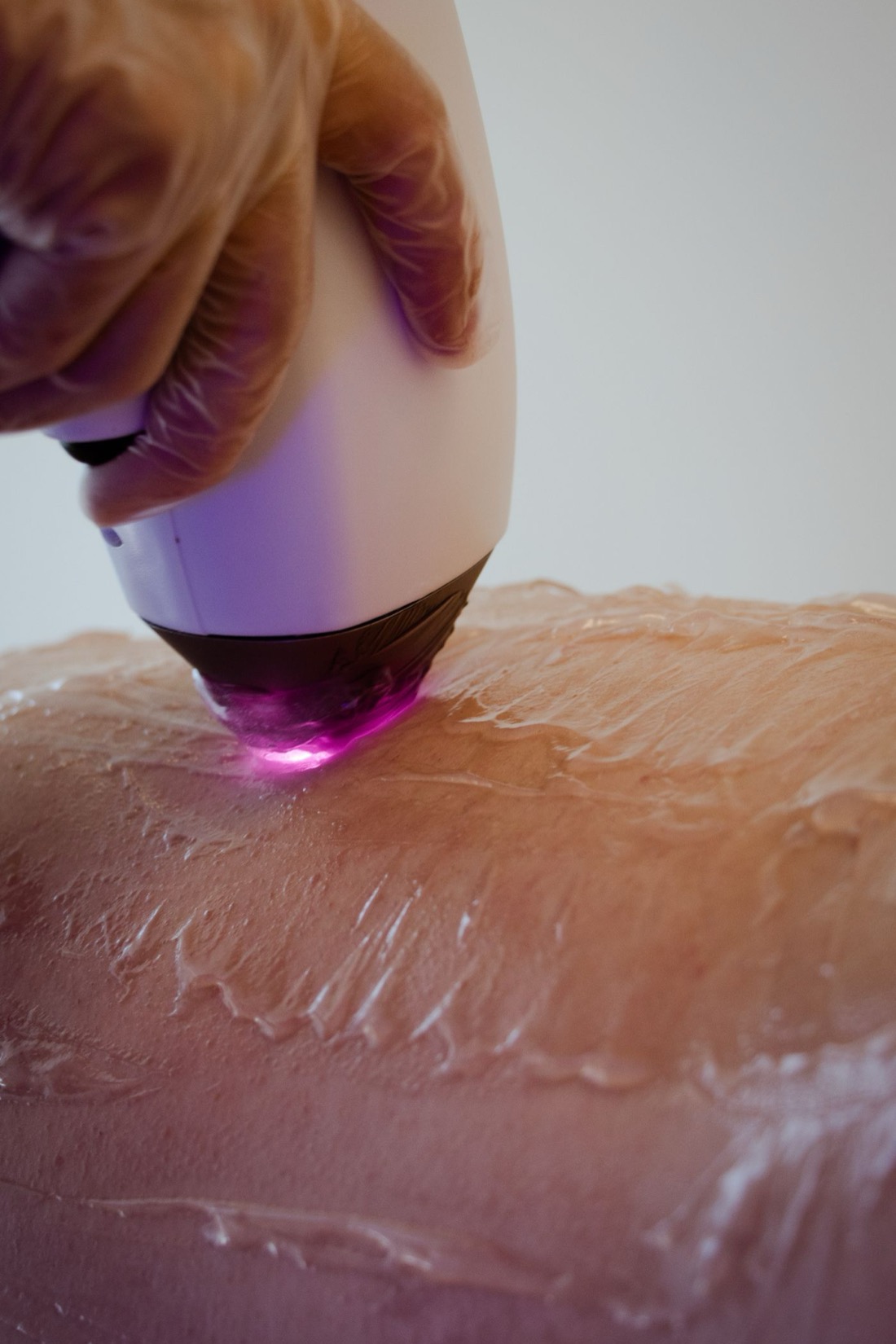 Diodenlaser gibt einen Lichtimpuls durch das Kontaktgel auf die Haut ab